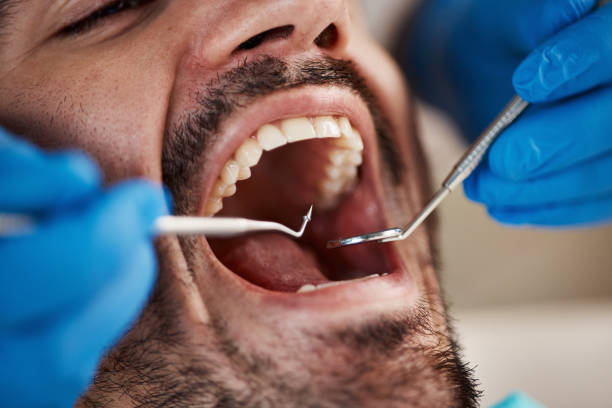 Best Emergency Wisdom Teeth Removal in Kamas, UT