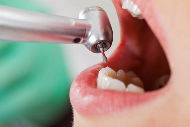 Best Emergency Dental Care for Broken or Chipped Teeth in Kamas, UT